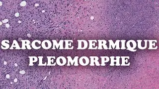 LE SARCOME DERMIQUE PLEOMORPHE – PATHOLOGIE