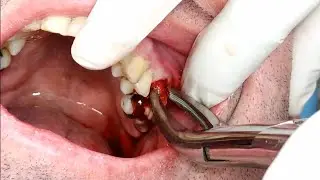 DENTAL SURGERY | See how to extract a tooth [COMPLETE PROCEDURE]