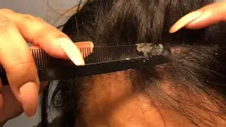 Dandruff Scratching: Big Flakes, Minimal Talking Pt. 1
