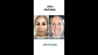 Take Your Skin To The Next Level | CARE Esthetics Bio-Filler