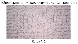 Ювенильная миоклоническая эпилепсия. Новая лекция.