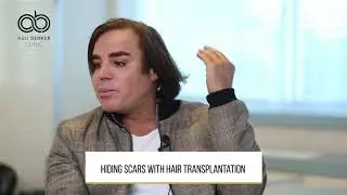 Hiding scars with hair transplantation