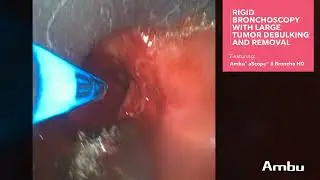 Rigid Bronchoscopy with Large Tumor Debulking and Removal | Dr. Hinze Using the aScope 5 Broncho HD