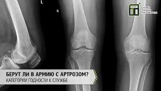 Do they take people with arthrosis into the army | Categories of fitness for service