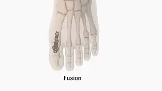 BioPro Hemi Toe Implant For Hallux Rigidus Animation