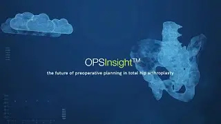 OPSInsight: preoperative planning for total hip arthroplasty