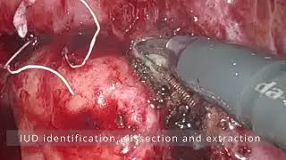 Robotic assisted removal of migrated IUD: a Video Vignette