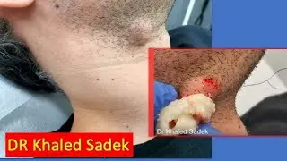 Hair raising cyst. Dr Khaled Sadek. LipomaCyst.com