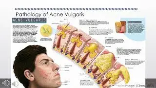 Effect of Probiotics on Acne Vulgaris