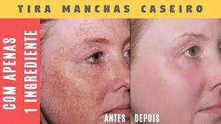 POTENTE TIRA MANCHAS DO ROSTO CASEIRO