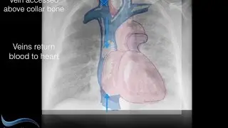Interventional Radiology Techniques - Permacath for Dialysis