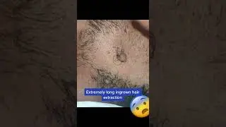 Ingrown Hair Super Zoom #내성 모발 #ingrownhair #내성발톱  #Shorts
