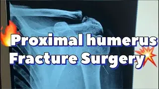 Proximal humerus fracture surgery #कंधे के हड्डी का ऑपरेशन #k-wiring #shoulder #fixation #oldage