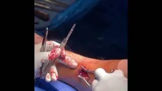 Ankle Fracture Surgery