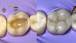 Class I Composite restoration