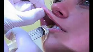 Injection des lèvres à l’acide hyaluronique - Dr Bernard Hayot