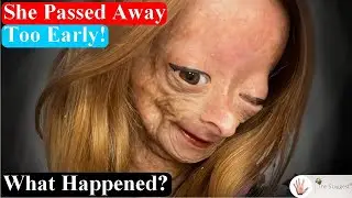 15-Years-Old Youtube Star Adalia Rose Left us Forever ~ Her Last Videos ~ Body Bizarre!