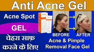 Mars by GHC Anti Acne Gel with Salicylic Acid | Best Gel For Acne |  Pimple marks removal Gel