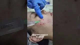 Лечение угревой болезни