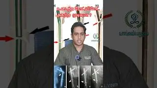 உடைந்த ரோட்/பிளேட் அகற்றுவது எப்படி|Broken Femur nail removal|Broken bone plate removal #fracture