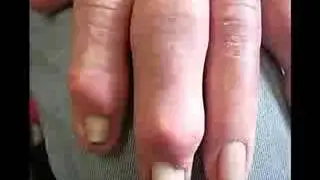 Symptom of Gout in Knee