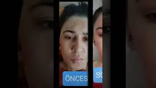 leke kremi setimizden gelen memnuniyet videosu