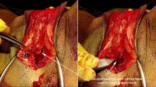 V07-01: Labia Minora Ring Flap Pars Fixa Urethroplasty and Perineal Masculinization