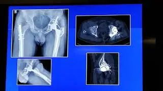 Acetabular bone defects