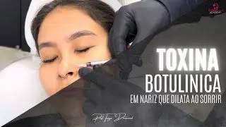 Toxina botulínica em nariz que dilata ao sorrir