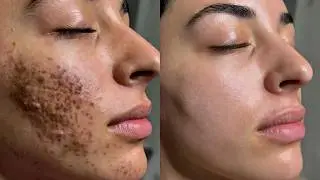 Full Face Blackhead Removal | Deep Pore Detox Facial Results