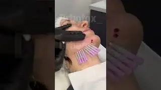 Нитевое армирование нижней трети лица.