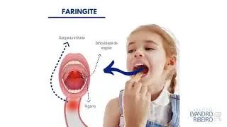 Amigdalites, faringites e laringites