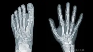 what is X-ray? How does it work?