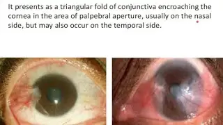 Pterygium | Ophthalmology