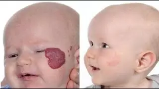 Current Management and Treatment of Infantil Hemangiomas