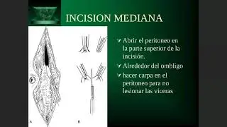TEC OPE 3 LAPAROTOMÍAS   DRENAJES