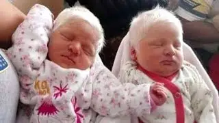 Parents Are Confused When Their Twins Are Born With Snow White Hair Until Doctors Share Diagnosis