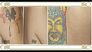 Tattoo Removal Cost, Products, Complications, Secret Tips