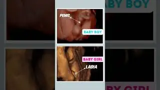 Baby boy v Girl baby | 4D | HD Ultrasound #baby #ultrasound