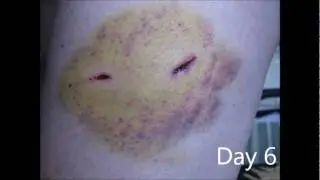 30 Day Dog Bite Wound