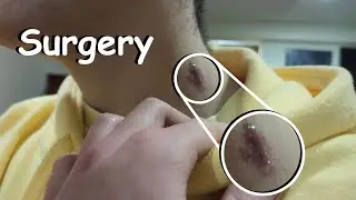 I had surgery