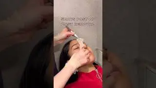 Rhinoplasty 1month post op!✨👃