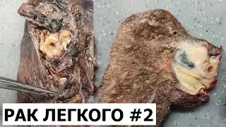 Рак легкого #2 - центральный рак легкого