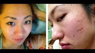 HOW TO REMOVE ACNE SCARS AT HOME FOR UNDER $60!