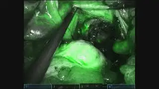 Anastomosi colorettale robotica sotto guida endoscopica e controllo con Verde di Indocianina