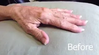 Restylane Lyft: Hand injection demo at Lipogenex