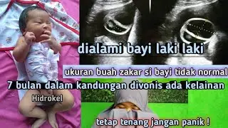 kelainan buah zakar pada bayi (hidrokel)