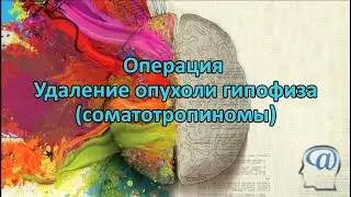 Операция. Удаление аденомы гипофиза (Соматотропиномы). Нейрохирургия. Pituitary adenoma surgery