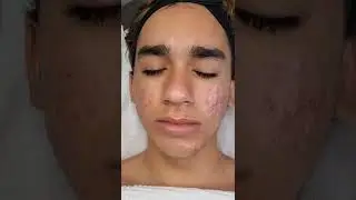 Acne Treatment #acne #acnetreatment #deepcleaning #acneremoval #acne #skincareroutine