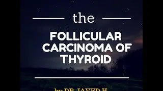 Follicular carcinoma of Thyroid